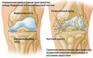 Болит колено при сгибании и ходьбе лечение