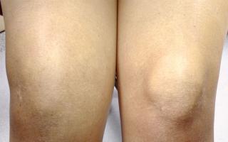 Почему опухло колено и болит: причины, диагностика и лечение