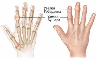 Características de la artrosis de las articulaciones de los dedos y su tratamiento.