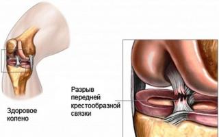 How to get rid of severe and sharp pain in the knee
