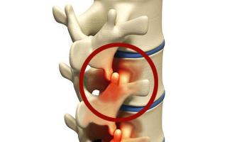 Modificări degenerative-distrofice ale coloanei vertebrale: cauze, simptome și tratament
