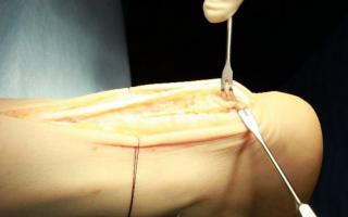 Aşil tendon kopması için ameliyat türleri