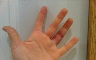 Mida teha, kui sõrm, pöial või väike sõrm on nihestatud: sümptomid ja põhjused, ravimeetodid