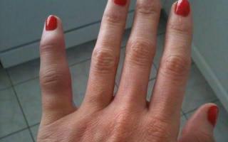 Як вправити палець на руці
