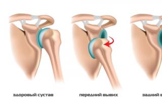 Cómo reducir y tratar una articulación del hombro dislocada