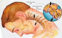 Pinched cervical nerve: symptoms and treatment