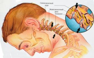 Nervio cervical pinzado: síntomas y tratamiento.
