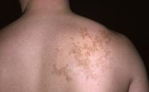 Galimos skausmo priežastys po dešine pečių ašmenimis už nugaros