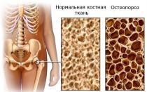Peties osteochondrozės simptomai ir gydymas