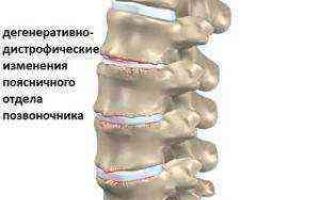 Lomber omurgada dejeneratif değişiklikler Lomber omurgada dejeneratif değişikliklerin MR belirtileri