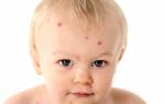 Food allergies: symptoms and treatment in infants Preventive measures to avoid allergic manifestations in the future