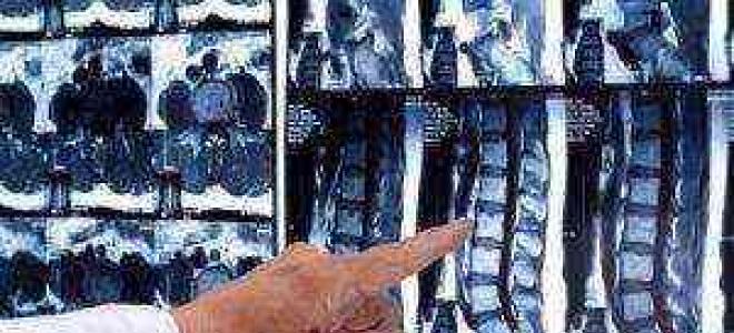 Cambios degenerativos en la columna lumbar: síntomas y tratamiento Cambios degenerativos iniciales en la columna lumbar