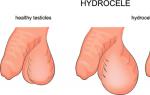 A child has testicular hydrocele - find out the symptoms, causes and treatment of the disease